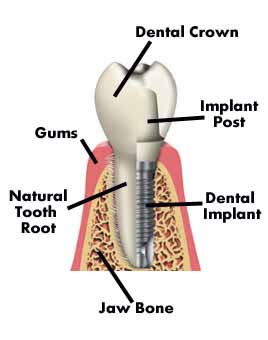 tooth_implant_diagram